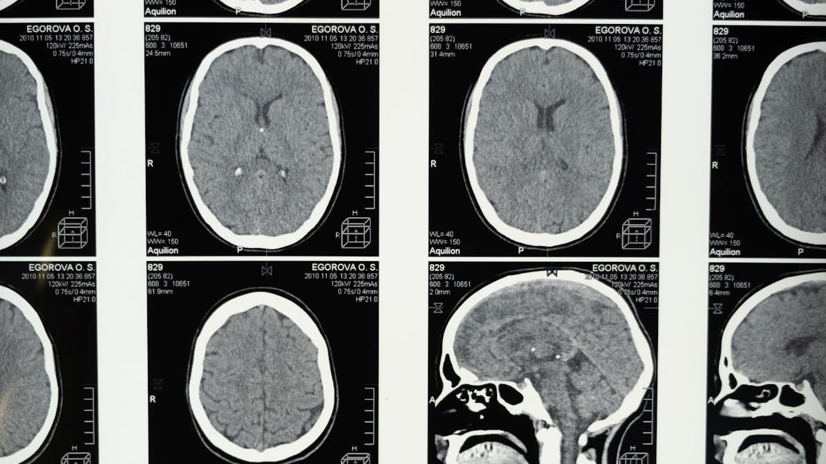 Acupuncture supporting neurological recovery and brain health, Chennai