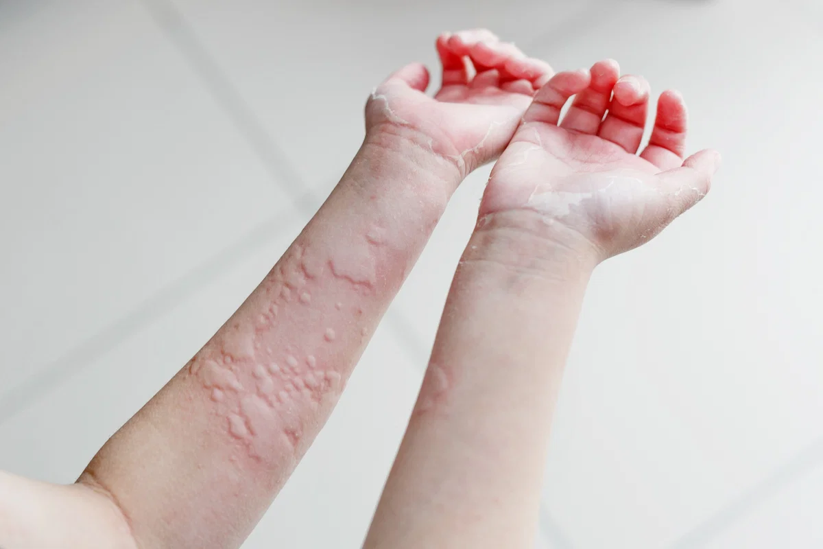 Acupuncture for skin conditions and holistic wellness at Aatral Acutherapy, Chennai
